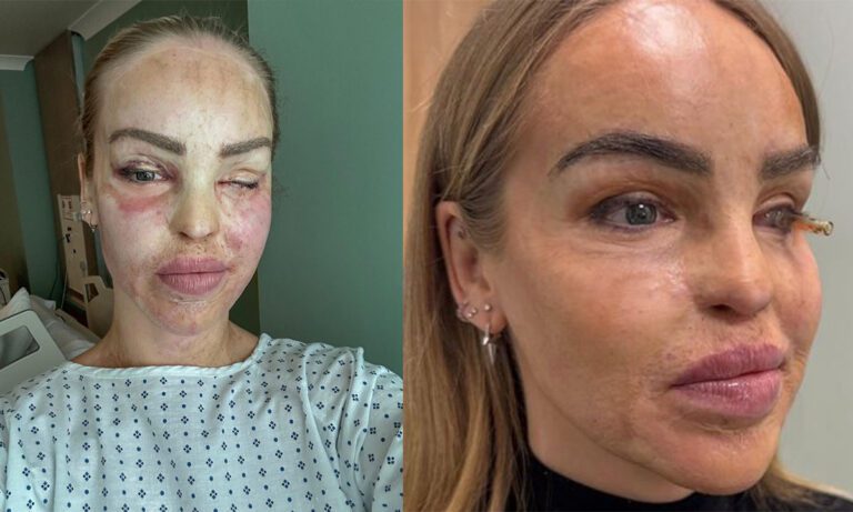 Katie Piper's brave decision to get prosthetic eyes after acid attack